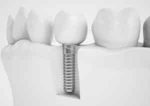 Dental,Implant