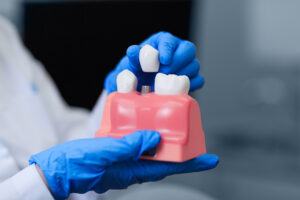 Real,Doctor,Holding,Model,Of,Teeth,With,Dental,Implant,,Closeup.